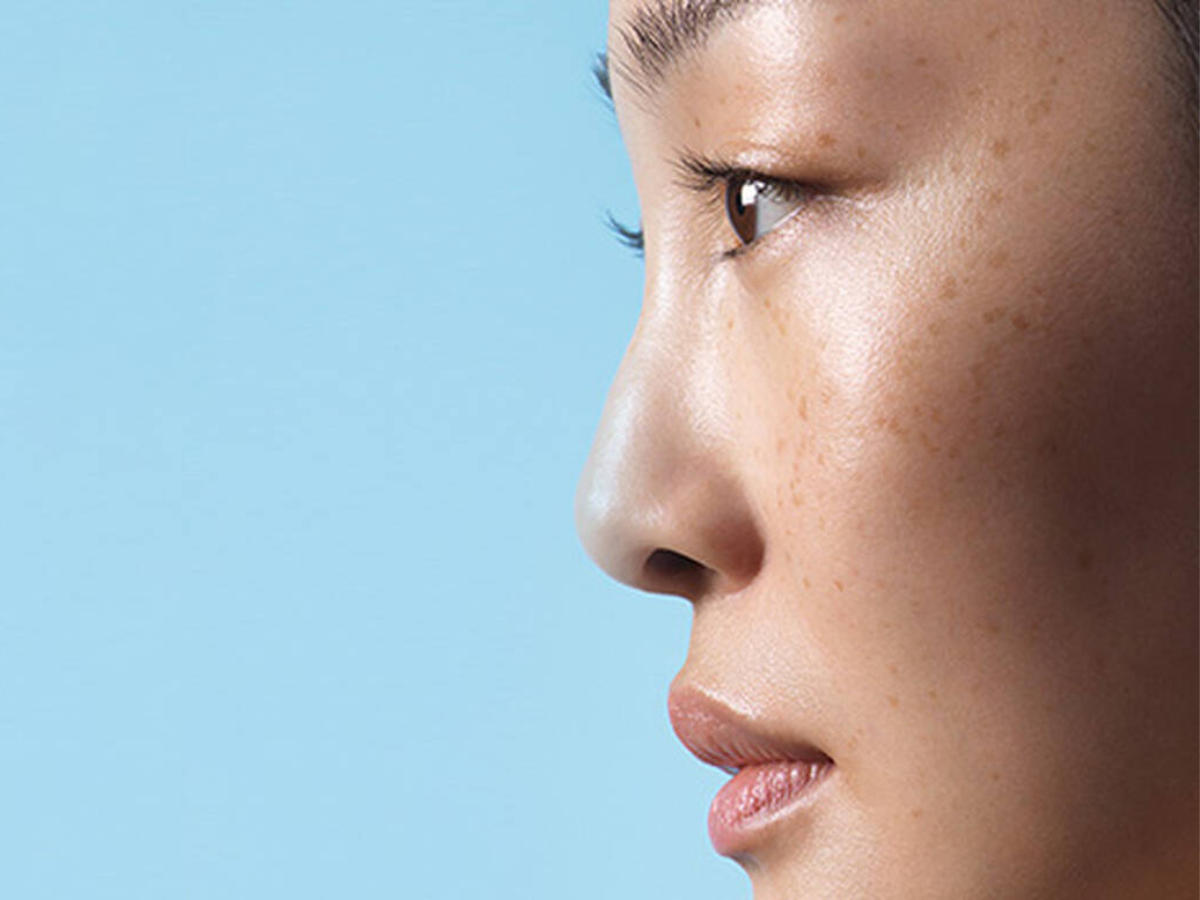 How to get rid of acne marks 👀