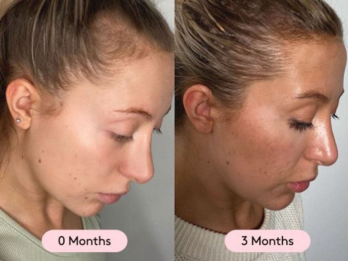 Say goodbye to thinning hair 👋 