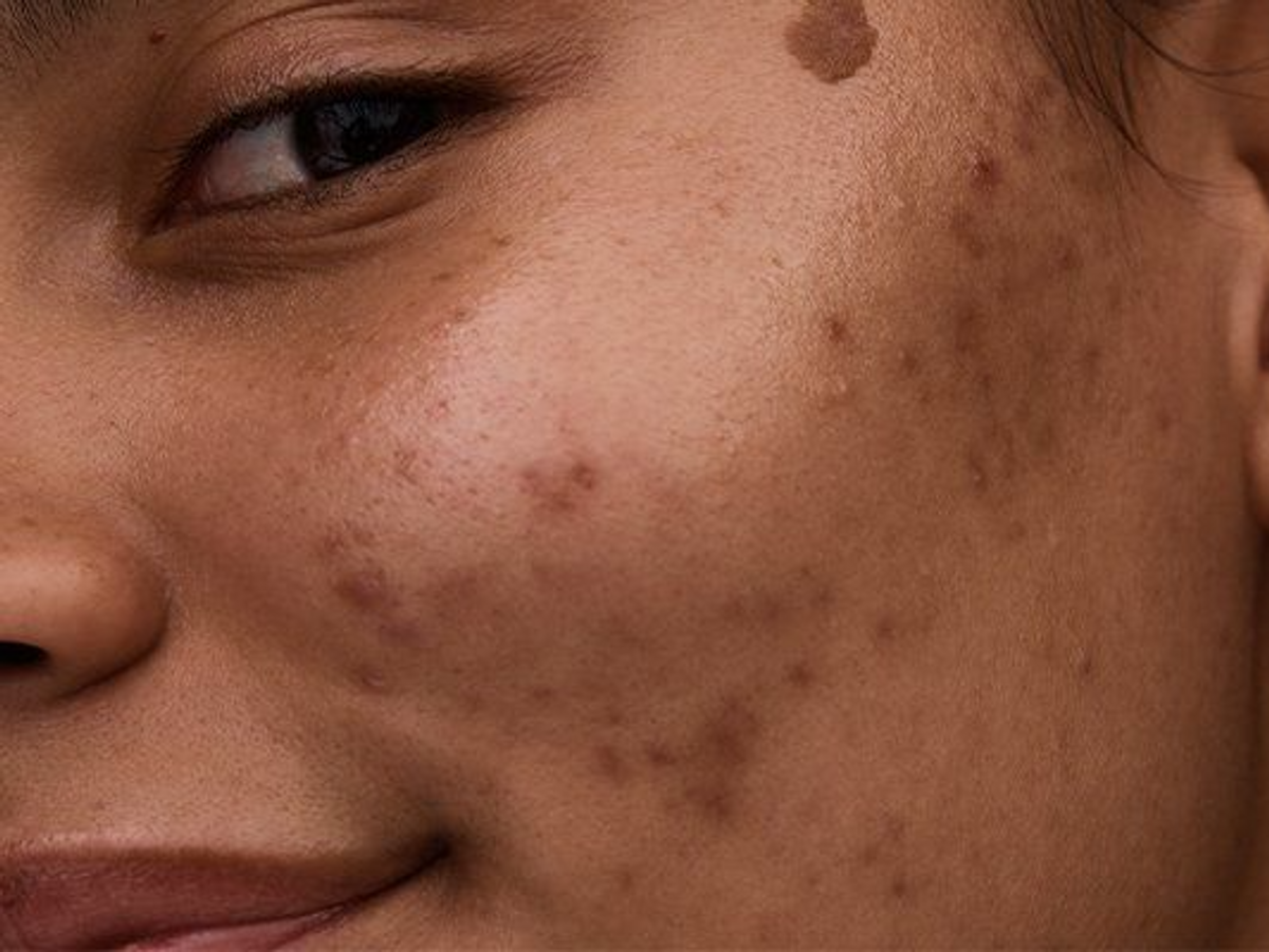 The Ultimate Guide to Salicylic Acid